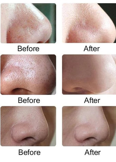 5 in 1 Black Head Remover Machine, Powerful Pimple Pore Cleaner, Vacuum Suction Tool, Rechargeable ‏Derma Suction